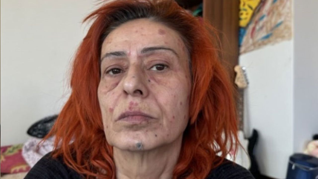 Yüzünde kimyasal yanık oluşmuştu! Yıldız Tilbe taşlı maskeyle poz verdi