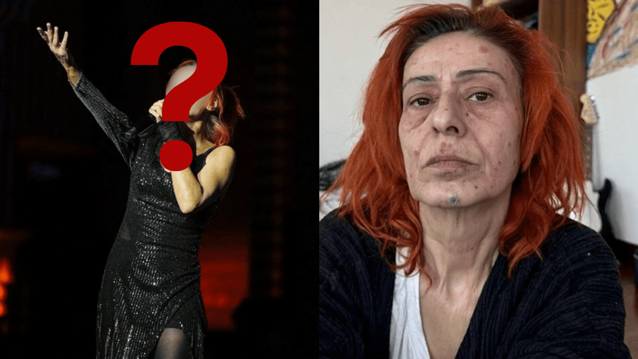 Yüzündeki yanıkları saklamak isteyen Yıldız Tilbe'nin buluşu şaşırttı!