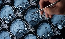 Tıp dünyasını şaşırtan vaka! En genç Alzheimer hastası olarak kayda geçti