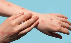 Okulda çiçek hastalığı alarmı! Bir sınıfta eğitime ara verildi