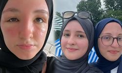 Denize giderken aman dikkat! Güneş zehirlenmesi genç kadının yüzünü bu hale getirdi