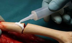 Tıp dünyasında heyecan yaratan buluş! Artık kırık tedavisi daha kolay oalcak