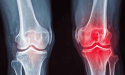 Diz Kireçlenmesinde Ameliyat Son Seçenek mi? Modern İğne Tedavileri ve Egzersizin Rolü