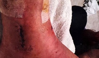 Arkeolojik kazı alanındaki çukura düştü 1 milyon lira tazminat kazandı