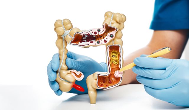Kalın bağırsak kanserinde erken teşhis için 5 belirtiye dikkat!