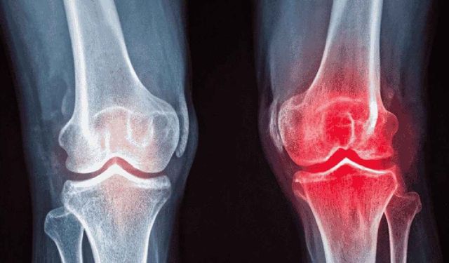 Diz Kireçlenmesinde Ameliyat Son Seçenek mi? Modern İğne Tedavileri ve Egzersizin Rolü