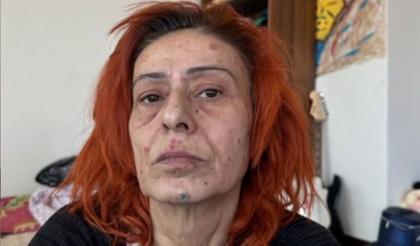 Tilbe, yüzünde kimyasal yanıklar oluştuğunu açıklayıp, “Bir daha saçıma boya sürmeyeceğim” ifadelerini kullanmıştı. 
