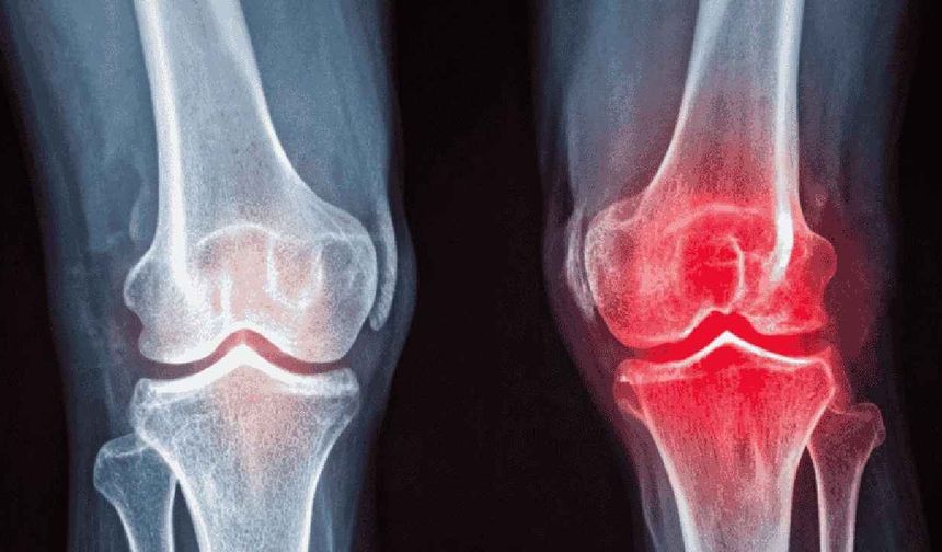 Diz Kireçlenmesinde Ameliyat Son Seçenek mi? Modern İğne Tedavileri ve Egzersizin Rolü